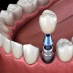 prosthodontics, tooth replacement, dental implants, dental bridges, dentures, crowns, Dallas Center for Oral Health & Wellness, Dr. Eugene Dahl, Dallas TX dentist, smile restoration