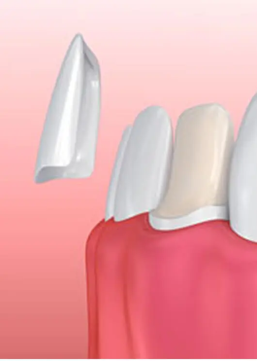 illustration of veneers