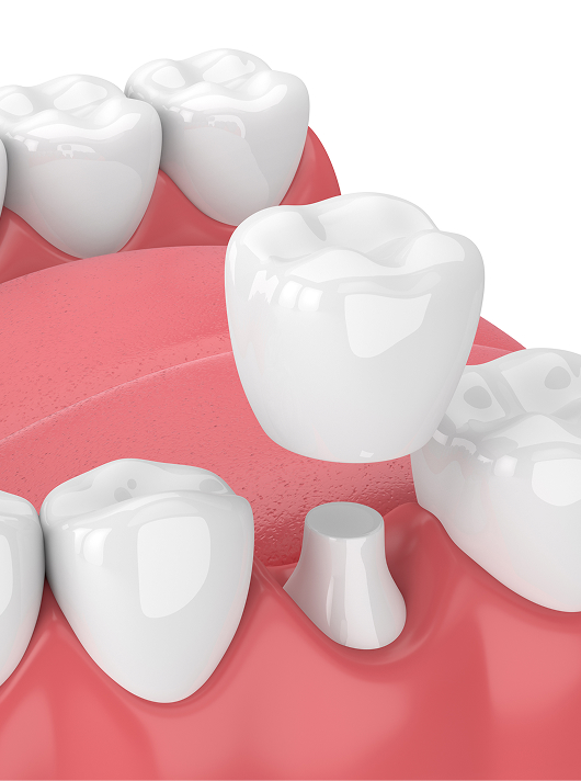 image of illustration of a dental crown