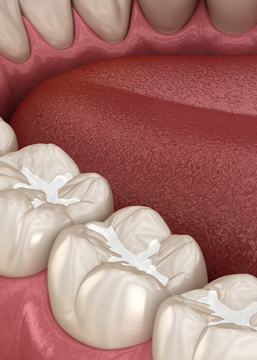 illustration of dental sealant